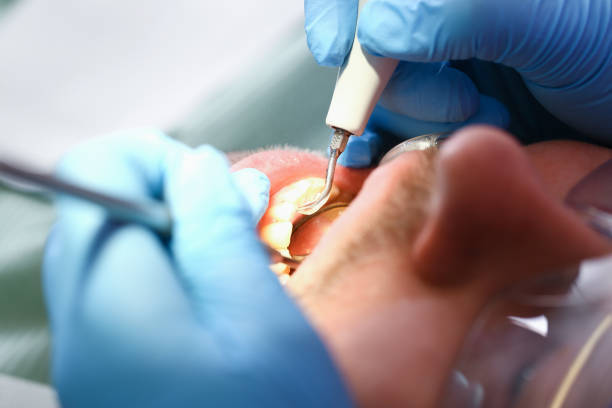 Best Emergency Wisdom Teeth Removal in Shelbyville, TN